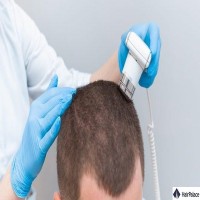 Get Effective Hair Loss Treatment in Glasgow Only at Trichology Scotla